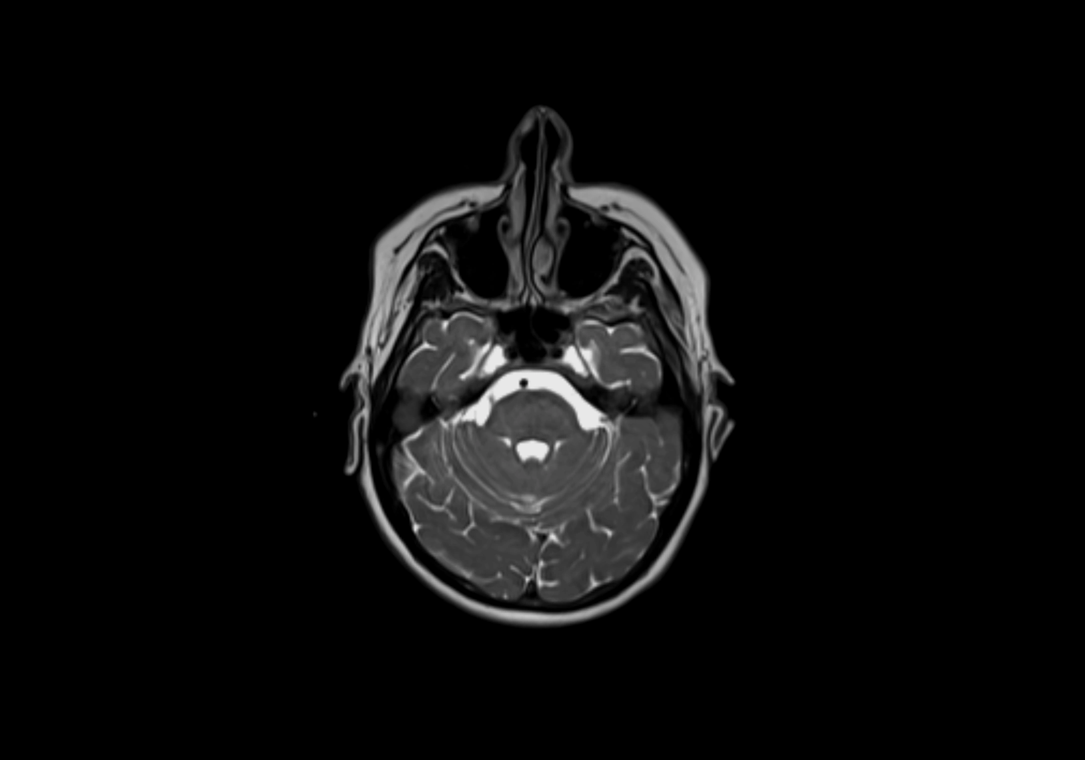 Neck axial  lymph node cross sectional MRI anatomy 3T MRI  image-img-00001-00012.webp
